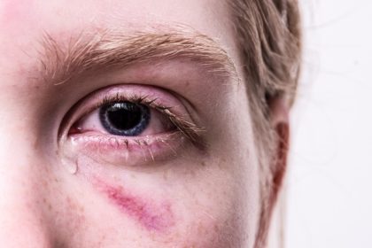 Male student with bruise under eye, close up